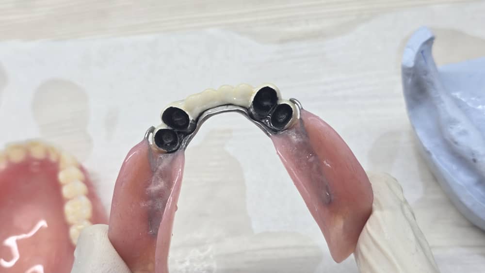 خدمات دندان‌سازی با لثه نرم و پروتزهای فلکسیبل در بوشهر