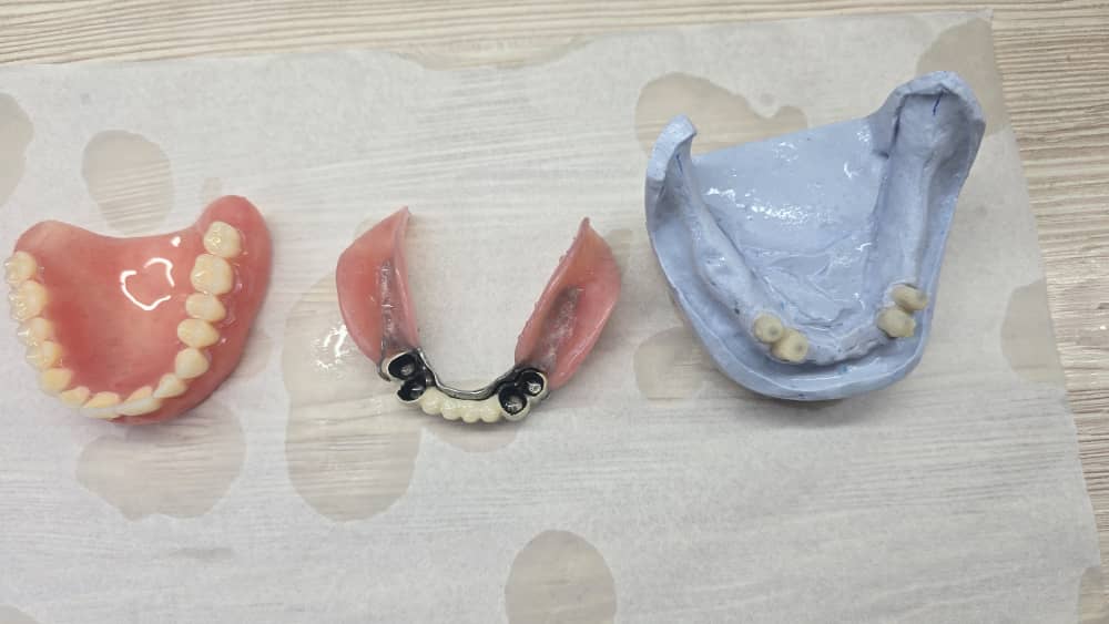 طرح تعویض دندان مصنوعی قدیمی