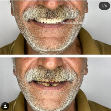 پروتز متحرک فک