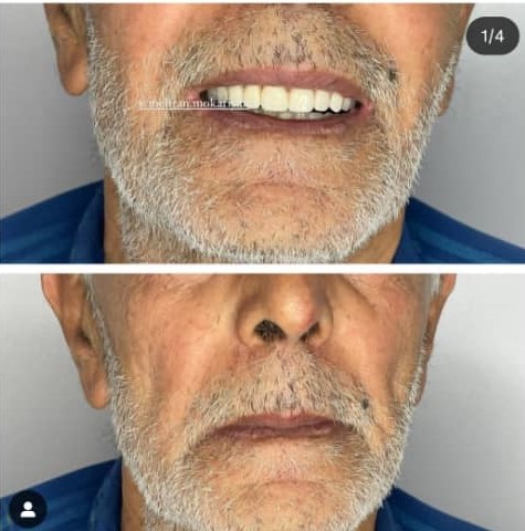 ساخت دنچر پارسیل