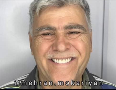 ساخت انواع دندان مصنوعی