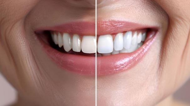 لمینت دندان چیست و چه زمانی بهترین گزینه است؟