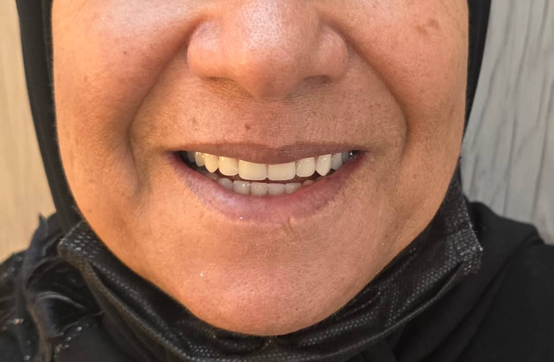 دنچر پارسیل آکریلیکی