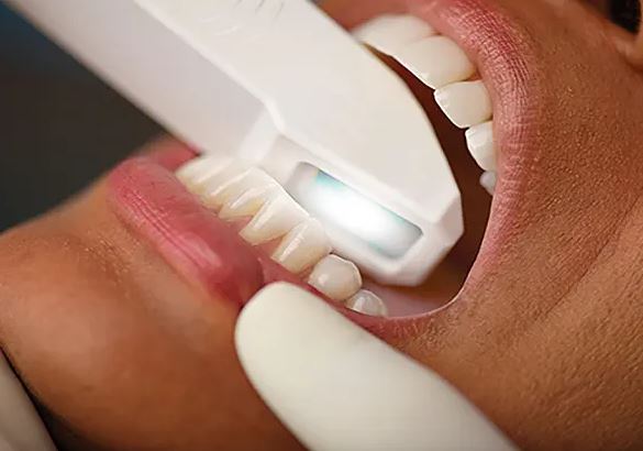 روش های پیشرفته قالب گیری دندان: راهنمایی برای دندان پزشکان و بیماران