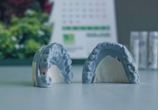 روش‌ های پیشرفته قالب گیری دندان: راهنمایی برای دندان‌ پزشکان و بیماران