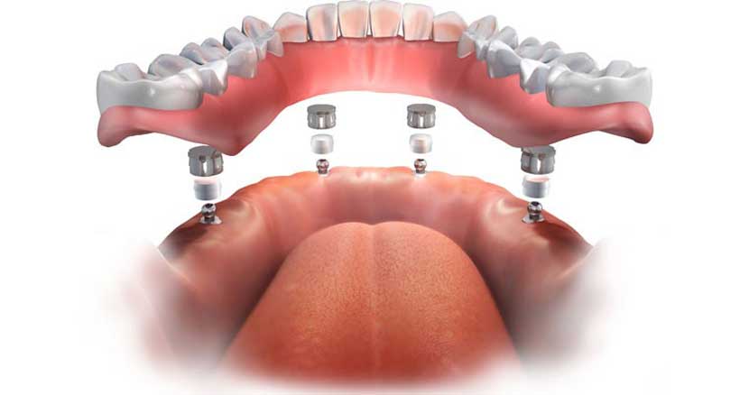 چطور پروتزهای دندانی می توانند ناهنجاری های فک را اصلاح کنند؟