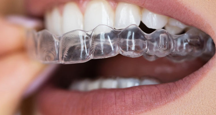 ارتودنسی نامرئی: چرا بهترین گزینه برای اصلاح دندان هاست؟