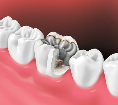 لق شدن ایمپلنت