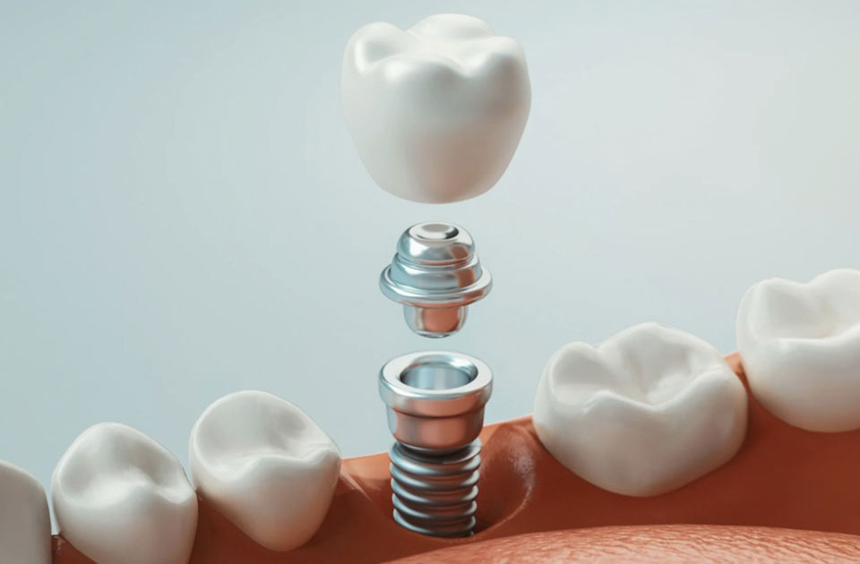 لق شدن ایمپلنت دندان: علل، درمان و پیشگیری