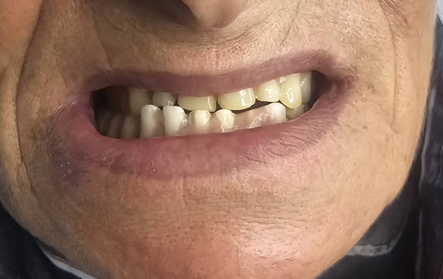 طرح تعویض دندان‌های مصنوعی با باز پرداخت اقساطی