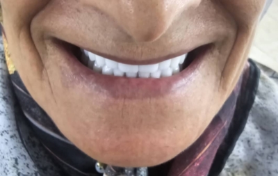 طرح تعویض دندان‌های مصنوعی با باز  پرداخت اقساطی